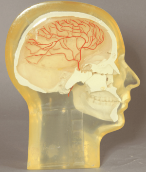Angiographic Head Phantom