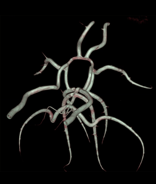 Circle of Willis