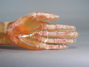 Fractured Hand/Forearm Phantom PH-2/2B